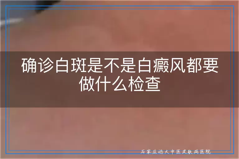 确诊白斑是不是白癜风都要做什么检查