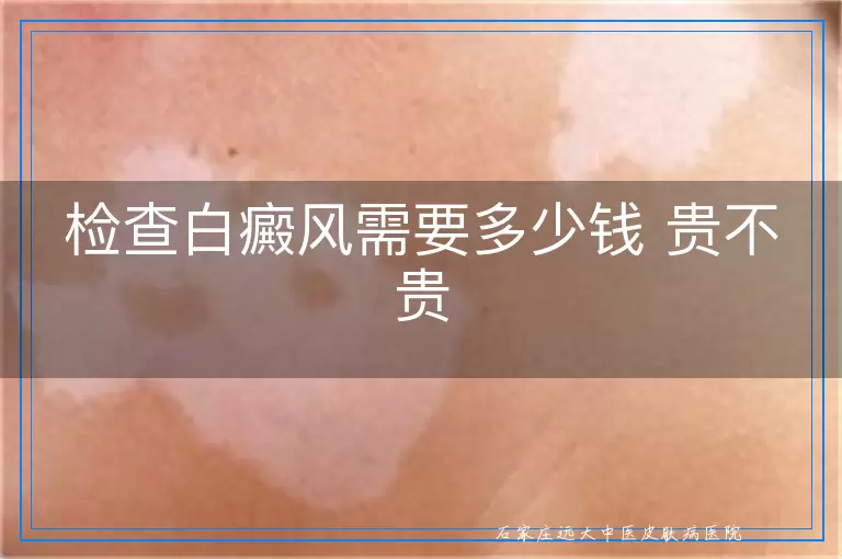 检查白癜风需要多少钱 贵不贵