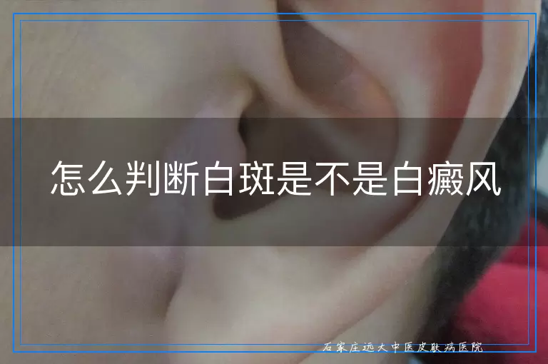怎么判断白斑是不是白癜风