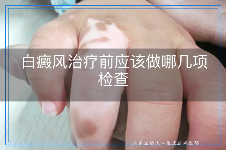 白癜风治疗前应该做哪几项检查