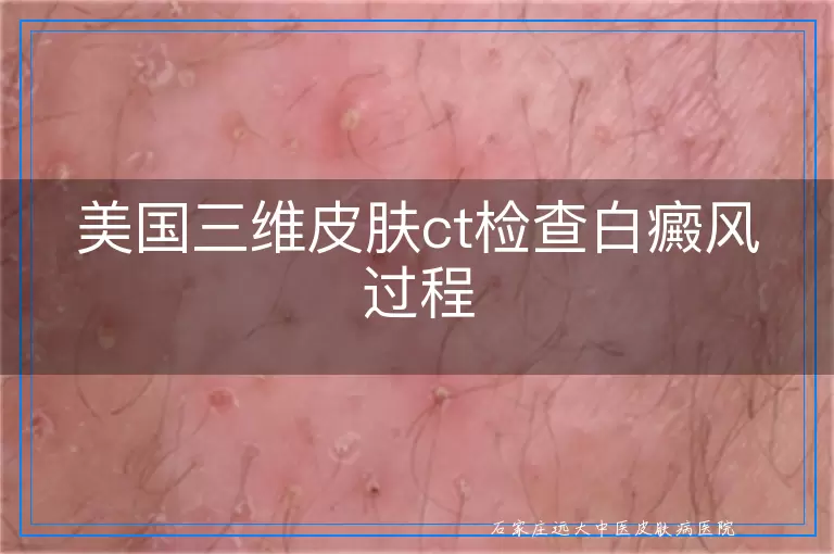 美国三维皮肤ct检查白癜风过程