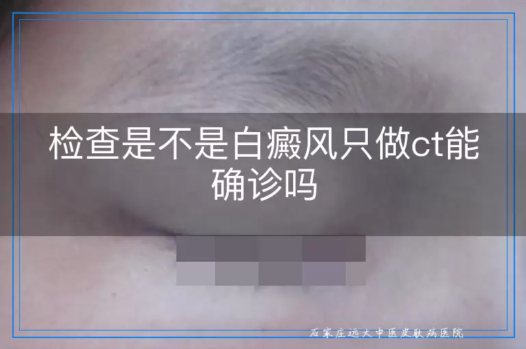 检查是不是白癜风只做ct能确诊吗