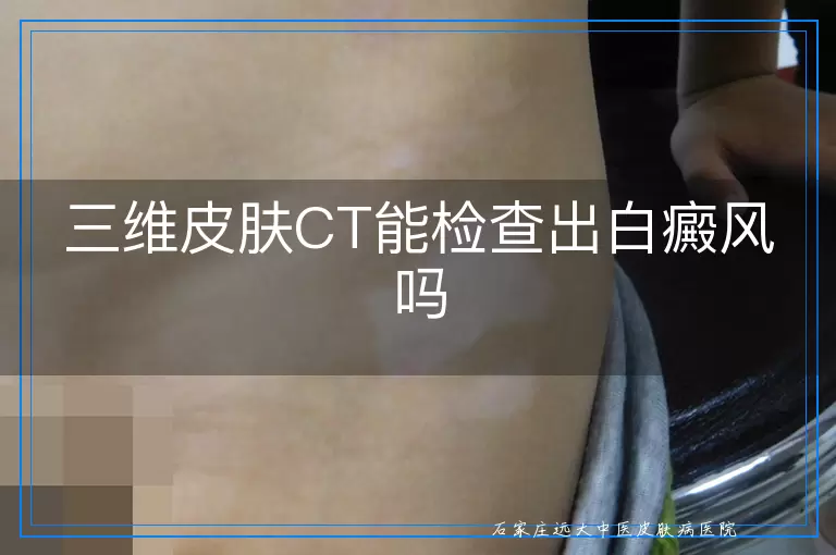 三维皮肤CT能检查出白癜风吗