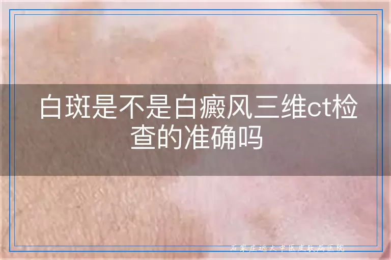 白斑是不是白癜风三维ct检查的准确吗