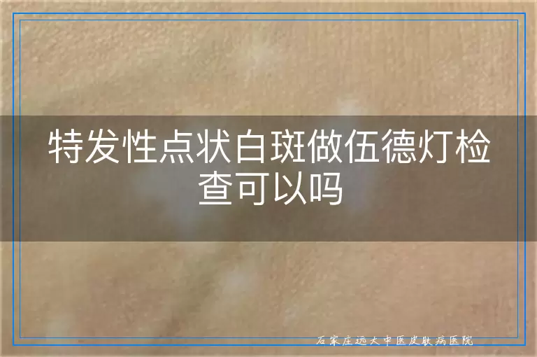 特发性点状白斑做伍德灯检查可以吗