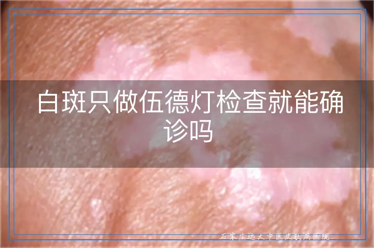 白斑只做伍德灯检查就能确诊吗