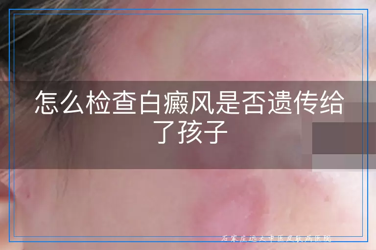 怎么检查白癜风是否遗传给了孩子