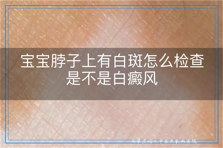 宝宝脖子上有白斑怎么检查是不是白癜风