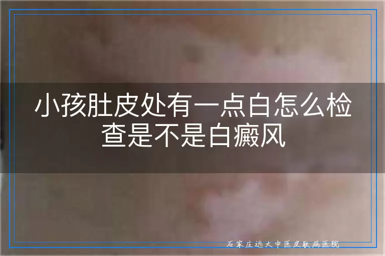小孩肚皮处有一点白怎么检查是不是白癜风