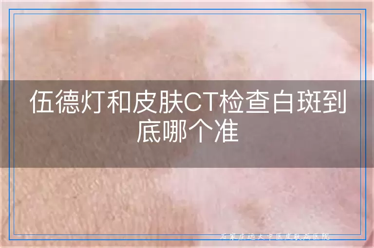 伍德灯和皮肤CT检查白斑到底哪个准
