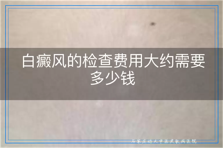 白癜风的检查费用大约需要多少钱