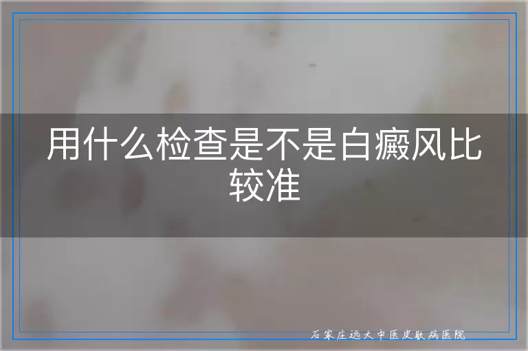 用什么检查是不是白癜风比较准