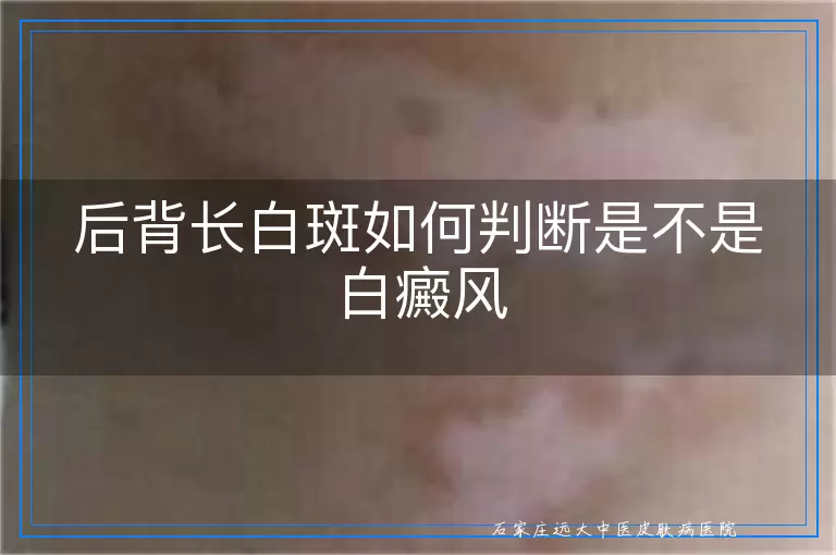 后背长白斑如何判断是不是白癜风