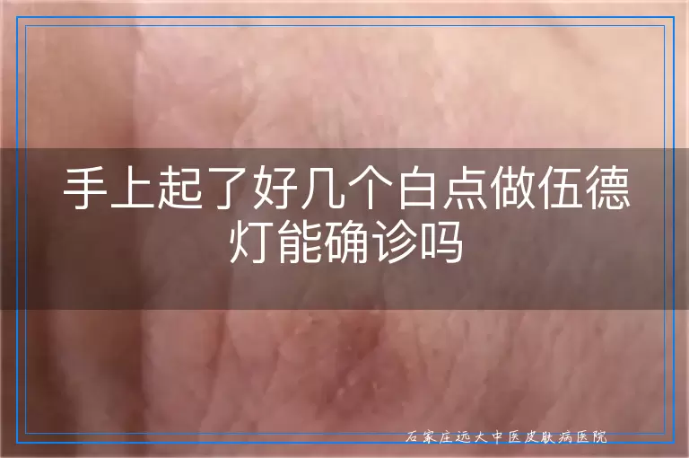 手上起了好几个白点做伍德灯能确诊吗