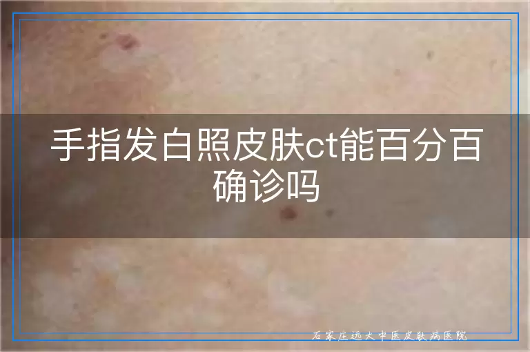 手指发白照皮肤ct能百分百确诊吗
