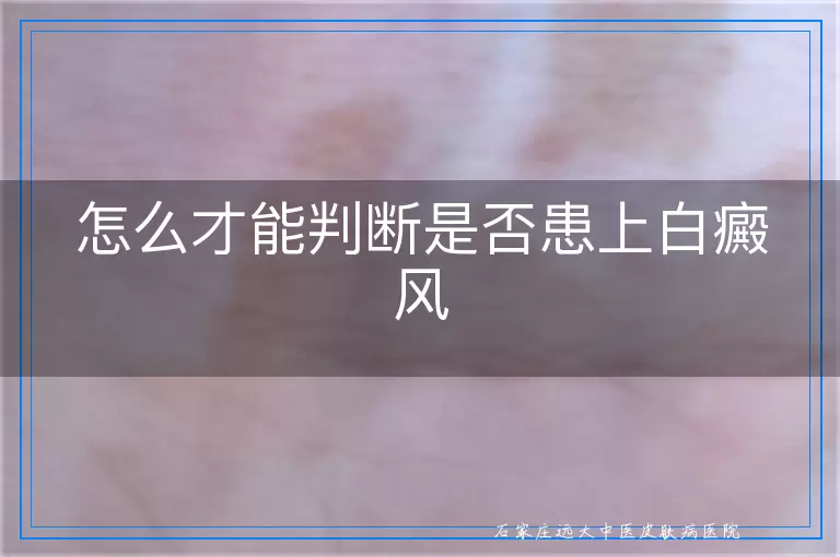怎么才能判断是否患上白癜风