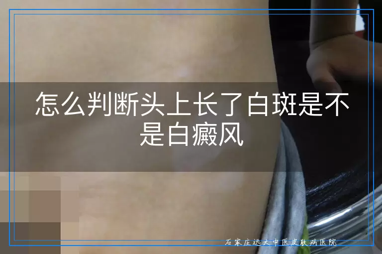 怎么判断头上长了白斑是不是白癜风