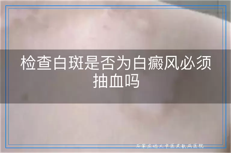 检查白斑是否为白癜风必须抽血吗