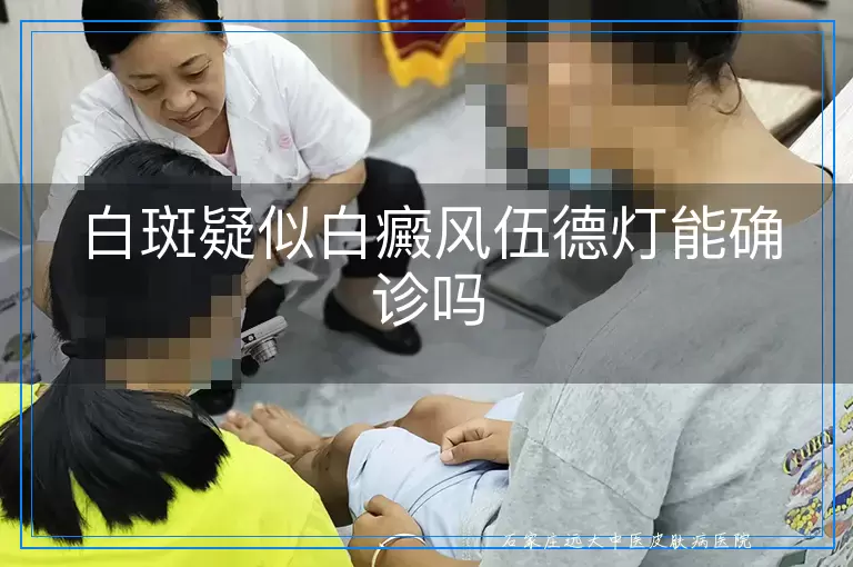 白斑疑似白癜风伍德灯能确诊吗