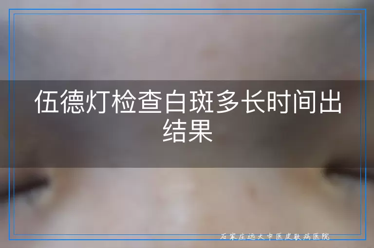 伍德灯检查白斑多长时间出结果