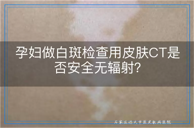 孕妇做白斑检查用皮肤CT是否安全无辐射？