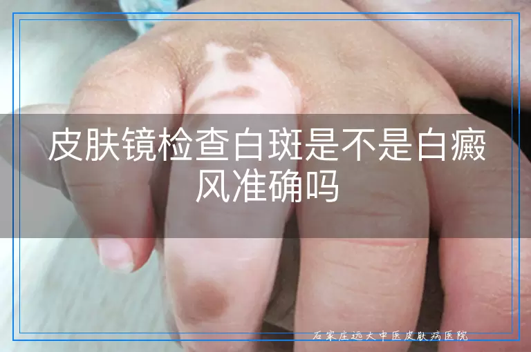 皮肤镜检查白斑是不是白癜风准确吗