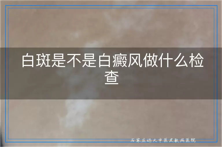 白斑是不是白癜风做什么检查