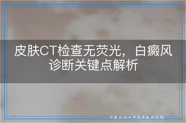 皮肤CT检查无荧光，白癜风诊断关键点解析