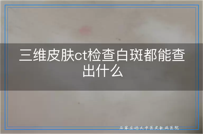 三维皮肤ct检查白斑都能查出什么