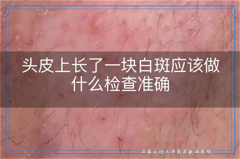 头皮上长了一块白斑应该做什么检查准确