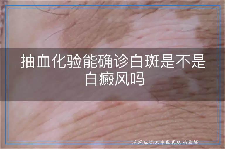 抽血化验能确诊白斑是不是白癜风吗