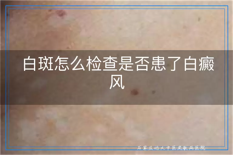 白斑怎么检查是否患了白癜风