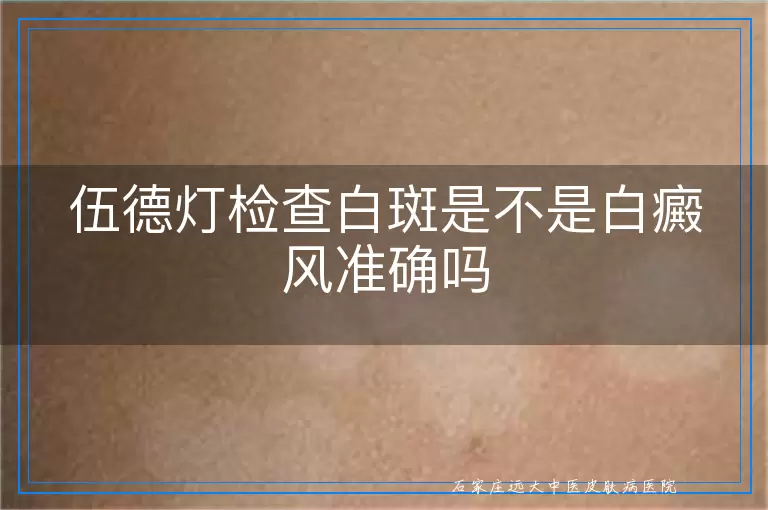 伍德灯检查白斑是不是白癜风准确吗