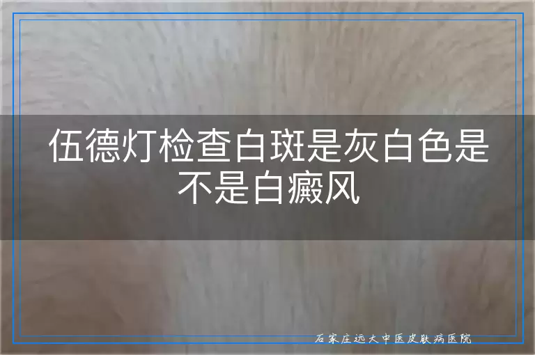 伍德灯检查白斑是灰白色是不是白癜风