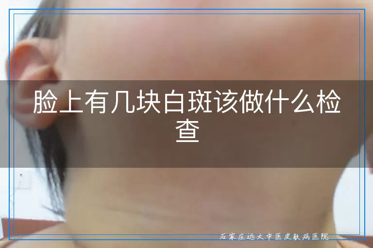 脸上有几块白斑该做什么检查