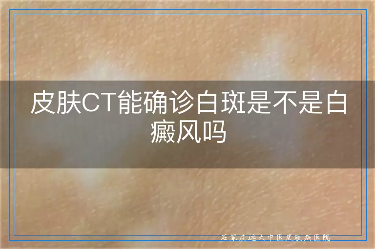 皮肤CT能确诊白斑是不是白癜风吗
