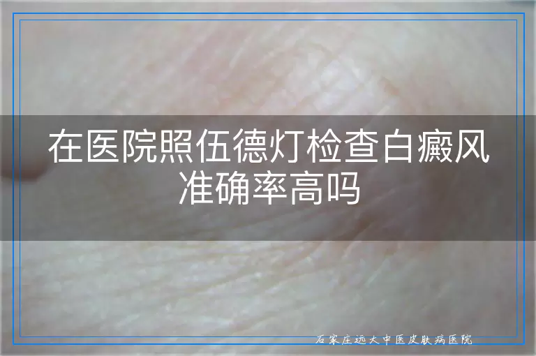 在医院照伍德灯检查白癜风准确率高吗