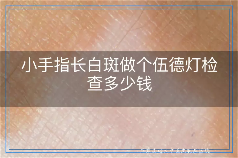 小手指长白斑做个伍德灯检查多少钱