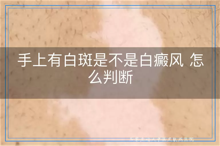 手上有白斑是不是白癜风 怎么判断
