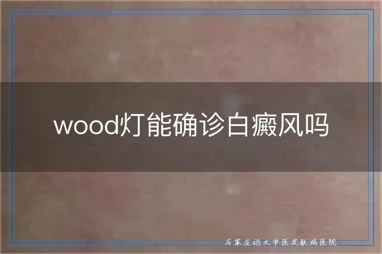 wood灯能确诊白癜风吗