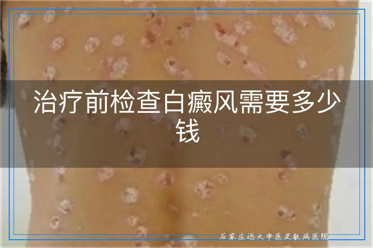 治疗前检查白癜风需要多少钱