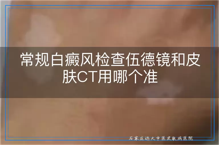 常规白癜风检查伍德镜和皮肤CT用哪个准