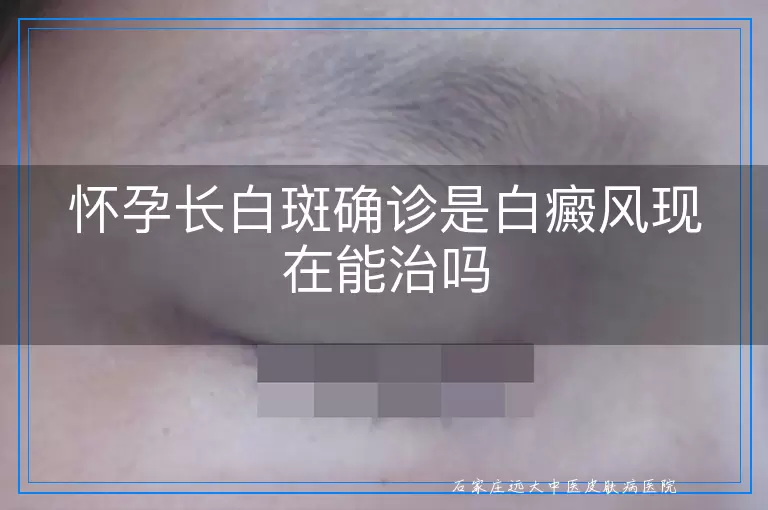 怀孕长白斑确诊是白癜风现在能治吗
