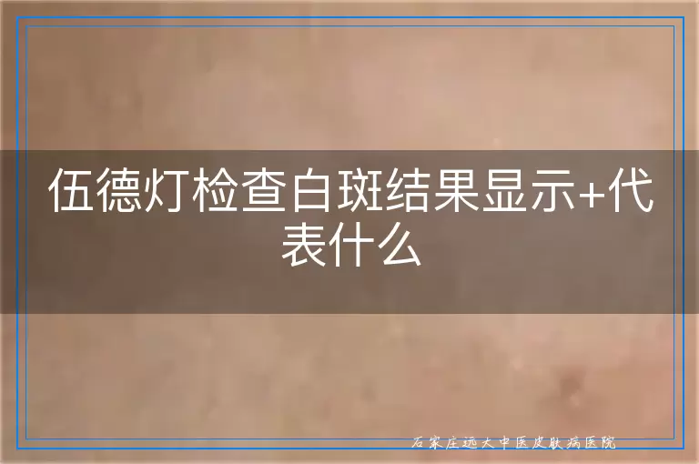 伍德灯检查白斑结果显示+代表什么
