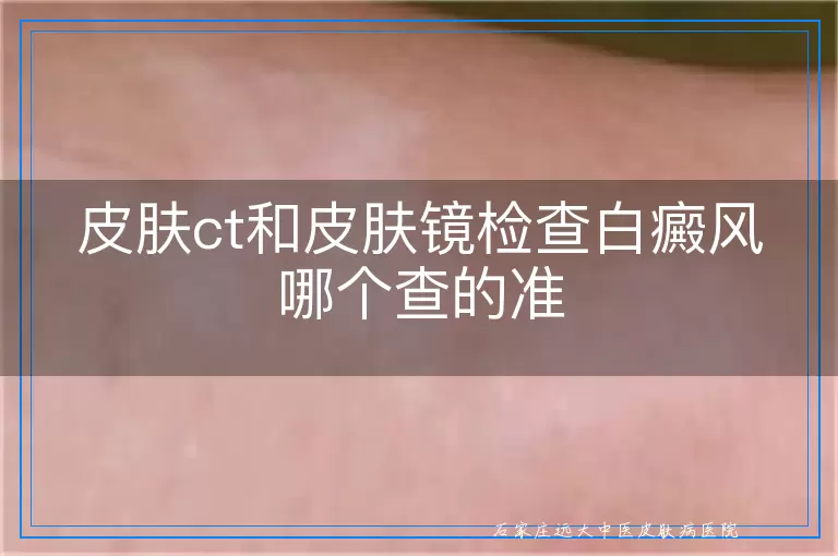 皮肤ct和皮肤镜检查白癜风哪个查的准