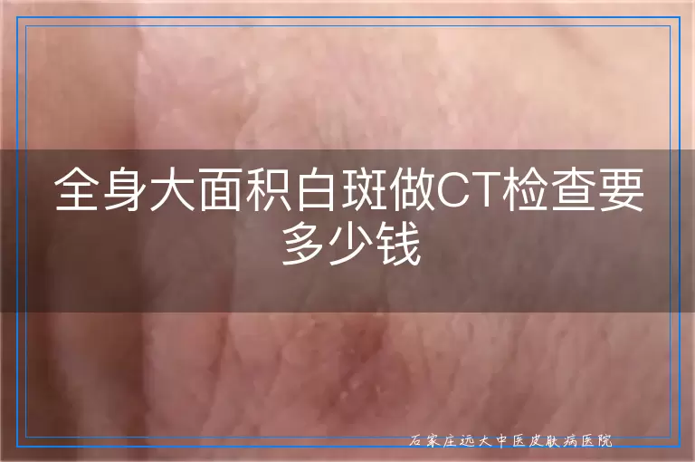 全身大面积白斑做CT检查要多少钱