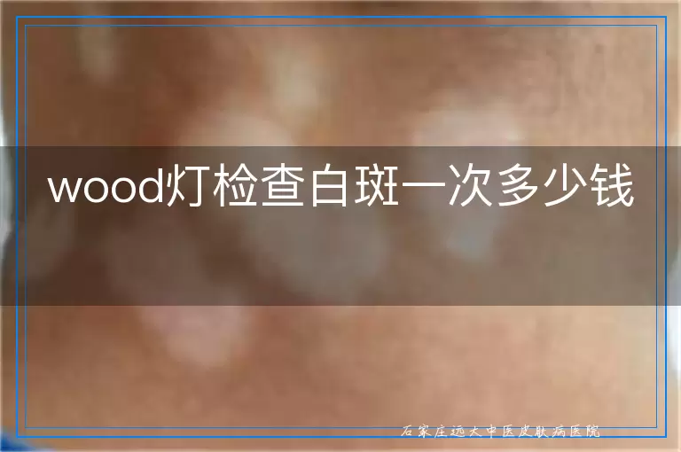 wood灯检查白斑一次多少钱
