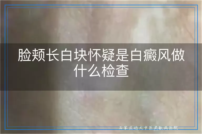 脸颊长白块怀疑是白癜风做什么检查