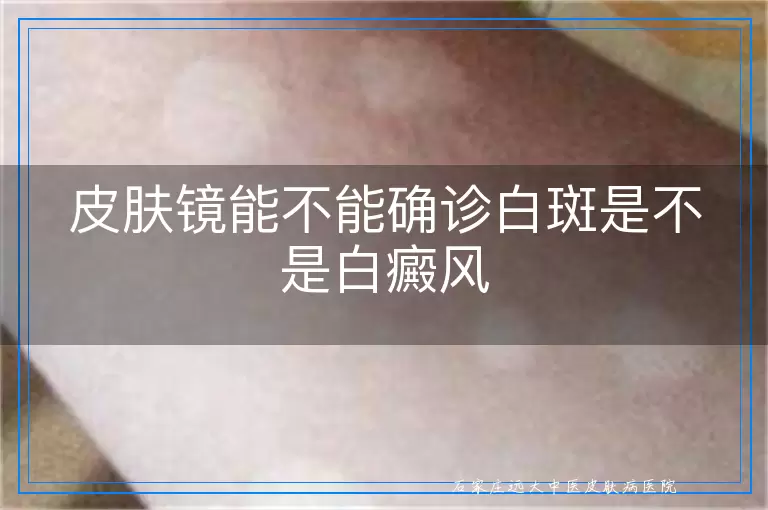 皮肤镜能不能确诊白斑是不是白癜风