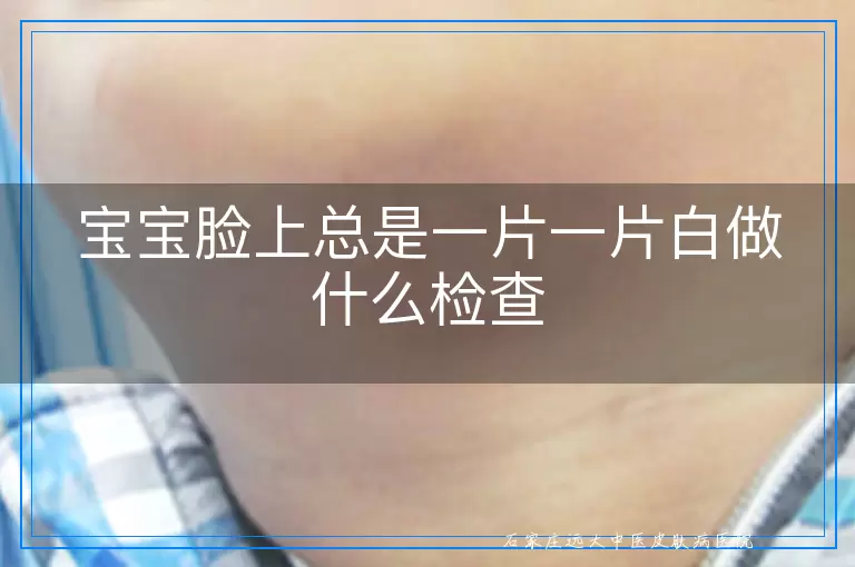 宝宝脸上总是一片一片白做什么检查